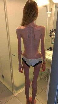 瘦得皮包骨的照片